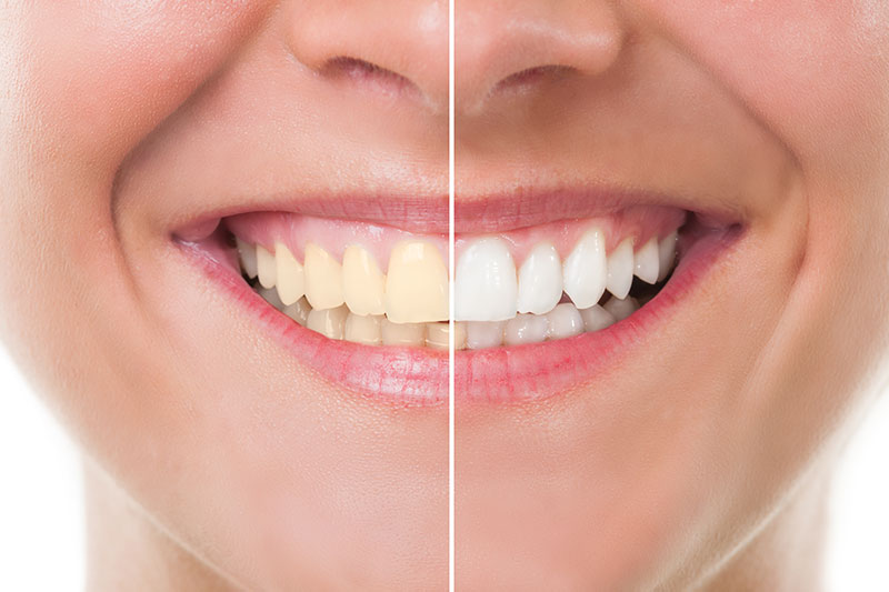 Teeth Whitening in Bastrop